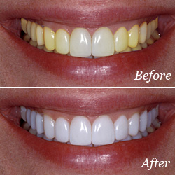 teeth whitening before and after